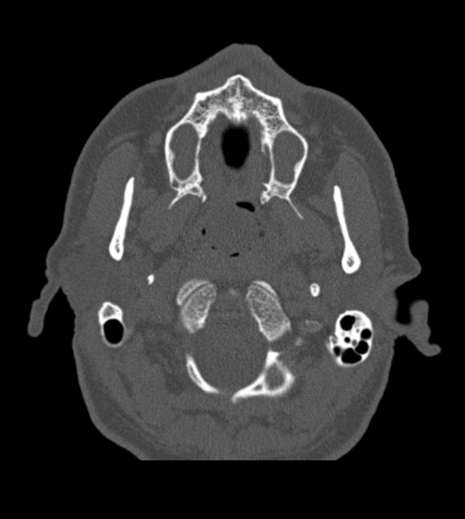 Antrochoanal polyp (Radiopaedia 79011-92169 Axial bone window 7).jpg