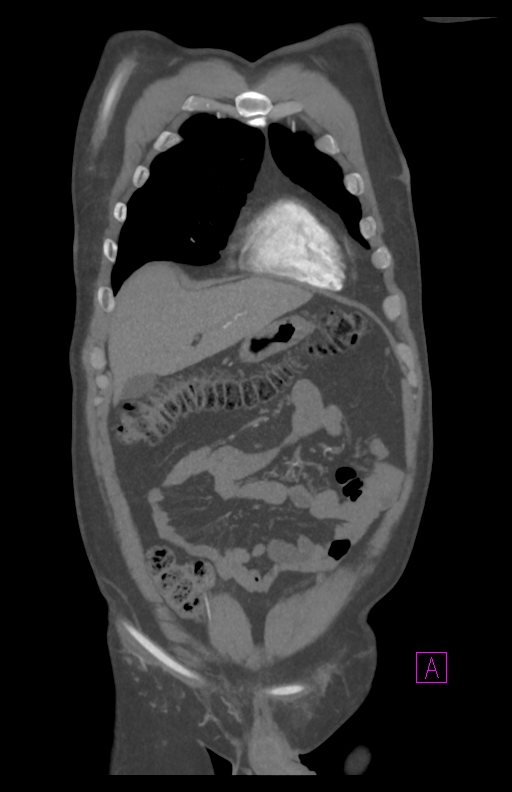 Aortectomy and axillary-bifemoral bypass (Radiopaedia 28303-28545 C 23).jpg