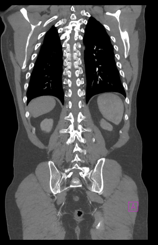Aortectomy and axillary-bifemoral bypass (Radiopaedia 28303-28545 C 71).jpg