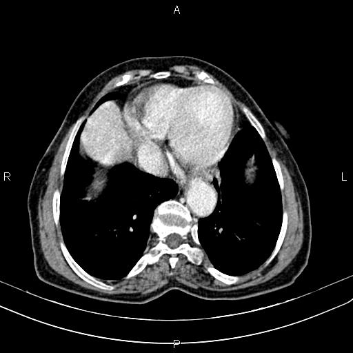 File:Aortic aneurysm and Lemmel syndrome (Radiopaedia 86499-102554 A 8).jpg
