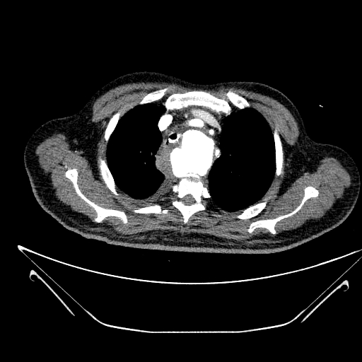 Aortic arch aneurysm (Radiopaedia 84109-99365 B 150).jpg