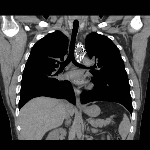 File:Aortic arch stent (Radiopaedia 30030-30595 Coronal non-contrast 13).jpg