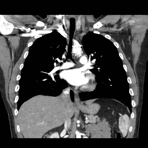 File:Aortic arch stent (Radiopaedia 30030-30595 F 14).jpg