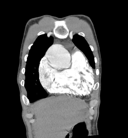 Aortic coarctation with aneurysm (Radiopaedia 74818-85828 C 21).jpg