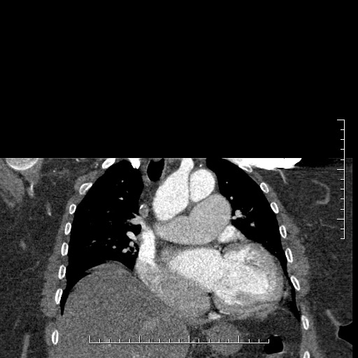 Aortic dissection- Stanford A (Radiopaedia 35729-37268 E 35).jpg