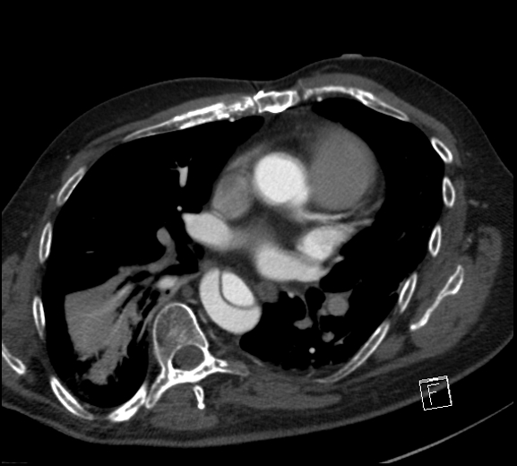 Aortic dissection (CTPA) (Radiopaedia 75506-86750 A 50).jpg