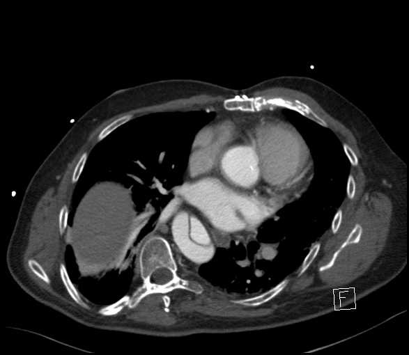 Aortic dissection (CTPA) (Radiopaedia 75506-86750 E 6).jpg