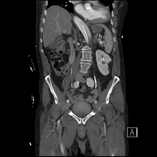 Aortic dissection (CTPA) (Radiopaedia 75506-86750 F 34).jpg