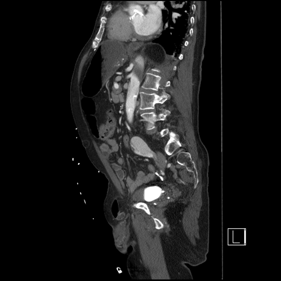 Aortic dissection (CTPA) (Radiopaedia 75506-86750 G 66).jpg