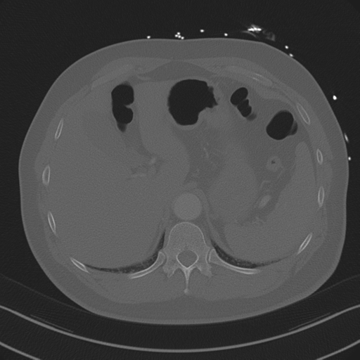 Aortic dissection (Radiopaedia 50763-56234 Axial bone window 95).png
