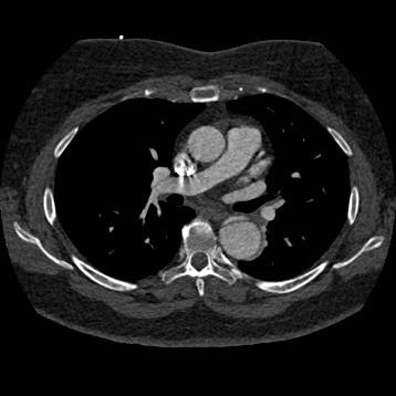 File:Aortic dissection (Radiopaedia 57969-64959 A 145).jpg