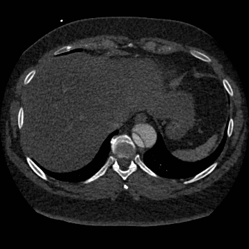 File:Aortic dissection (Radiopaedia 57969-64959 A 254).jpg