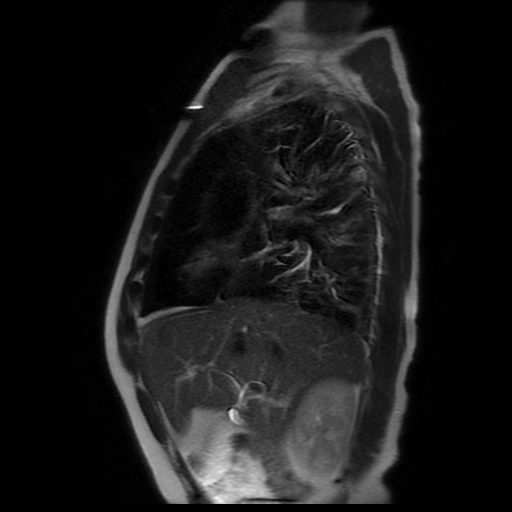 File:Aortic dissection - Stanford A -DeBakey I (Radiopaedia 28339-28586 Sagittal T2 19).jpg