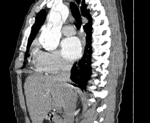 File:Aortic dissection - Stanford A -DeBakey I (Radiopaedia 28339-28587 C 15).jpg