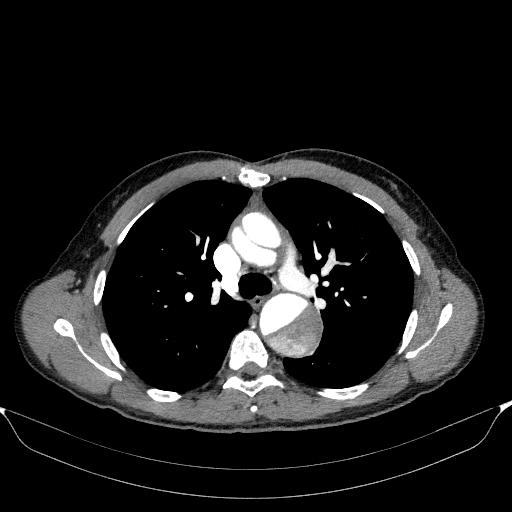 File:Aortic dissection - Stanford type A (Radiopaedia 83418-98500 A 25).jpg