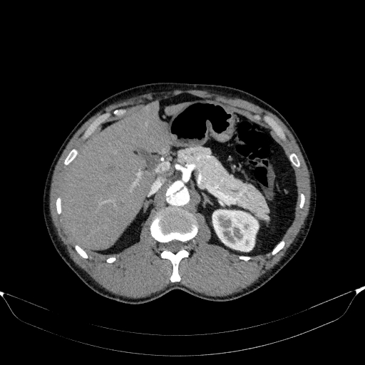 File:Aortic dissection - Stanford type A (Radiopaedia 83418-98500 A 66).jpg