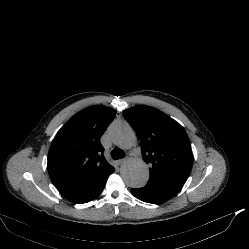 File:Aortic dissection - Stanford type A (Radiopaedia 83418-98500 Axial non-contrast 15).jpg