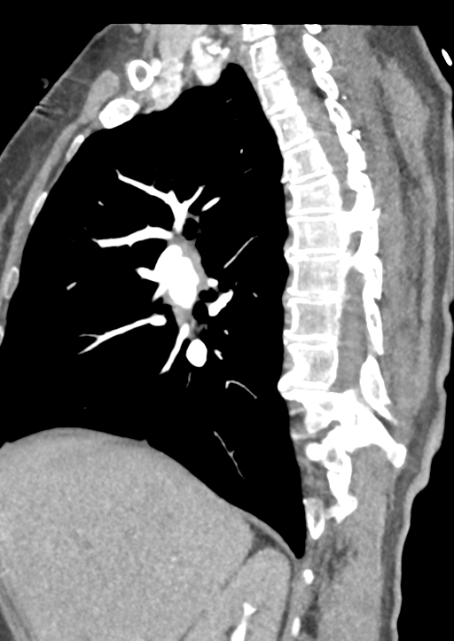 Aortic dissection - Stanford type B (Radiopaedia 50171-55512 C 44).png