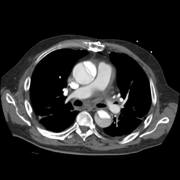 Aortic dissection with rupture into pericardium (Radiopaedia 12384-12647 A 25).jpg