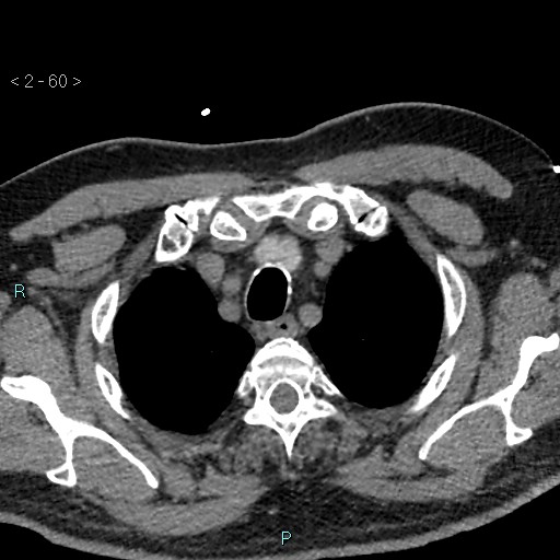 Aortic intramural hematoma (Radiopaedia 48463-53380 Axial non-contrast 26).jpg