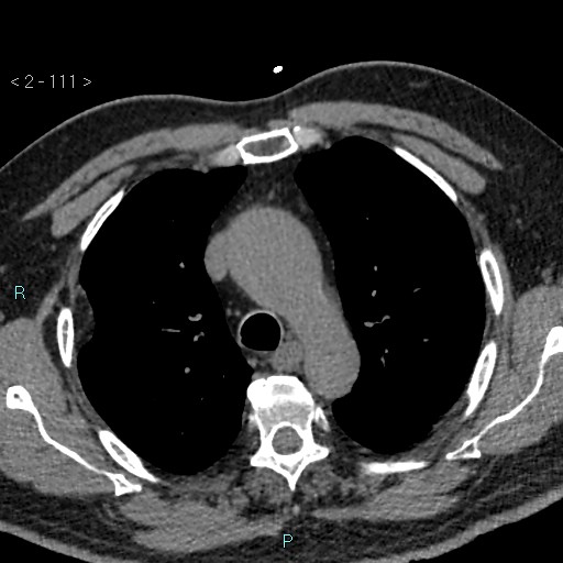 File:Aortic intramural hematoma (Radiopaedia 48463-53380 Axial non-contrast 49).jpg