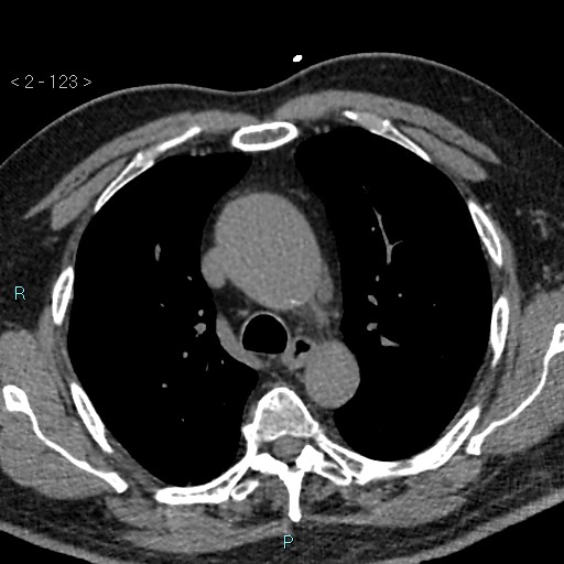 Aortic intramural hematoma (Radiopaedia 48463-53380 Axial non-contrast 55).jpg