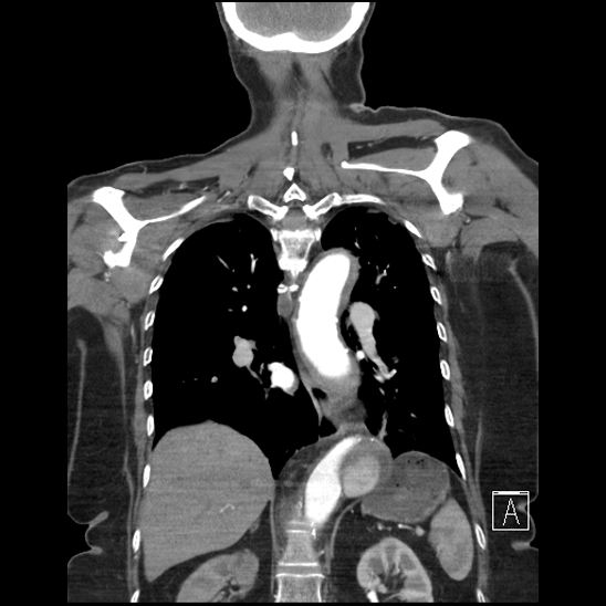 Aortic intramural hematoma with dissection and intramural blood pool (Radiopaedia 77373-89491 C 42).jpg