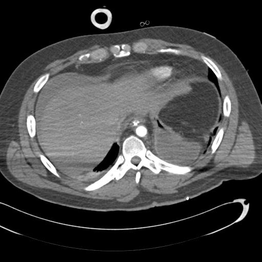 Aortic transection, diaphragmatic rupture and hemoperitoneum in a complex multitrauma patient (Radiopaedia 31701-32622 A 68).jpg