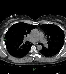 File:Aortic valve endocarditis (Radiopaedia 87209-103485 Axial non-contrast 47).jpg