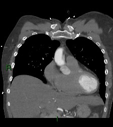 File:Aortic valve endocarditis (Radiopaedia 87209-103485 D 49).jpg