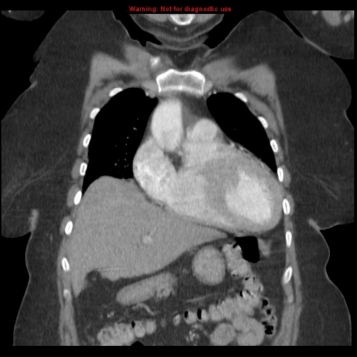 File:Aortic valve stenosis (Radiopaedia 14480-14423 A 1).jpg