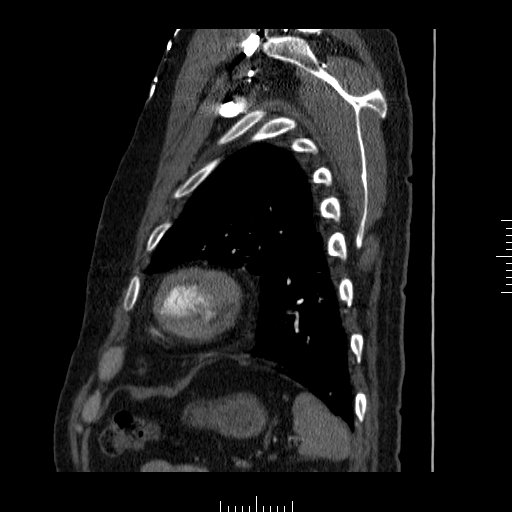 File:Aorto-coronary bypass graft aneurysms (Radiopaedia 40562-43157 C 36).png
