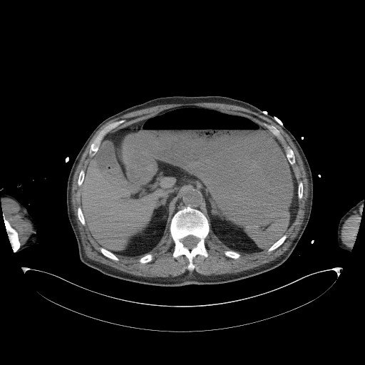 Aortoduodenal fistula (Radiopaedia 75286-86415 Axial non-contrast 15).jpg