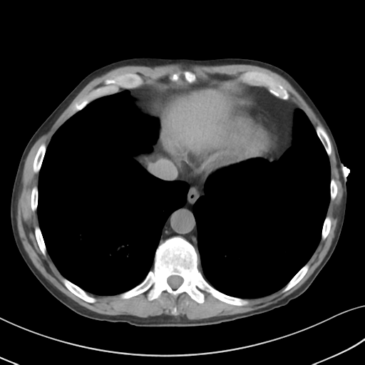 Apical pulmonary metastasis (Radiopaedia 46338-50754 B 50).png