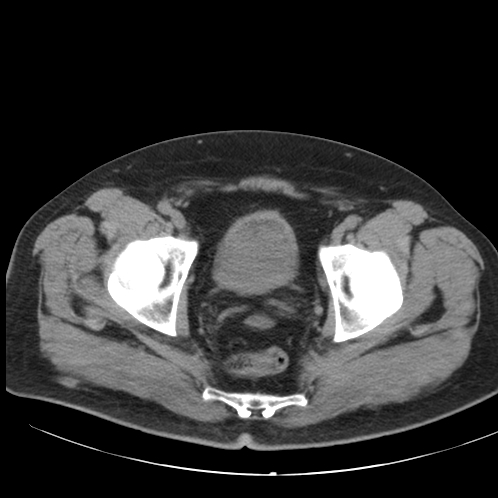 File:Appendicitis and giant appendicolith (Radiopaedia 80251-93588 Axial non-contrast 54).jpg