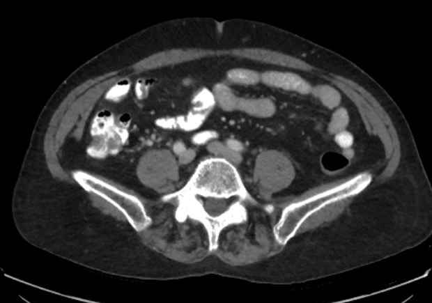 File:Appendicitis due to chicken fibula (Radiopaedia 74314-85198 A 8).jpg