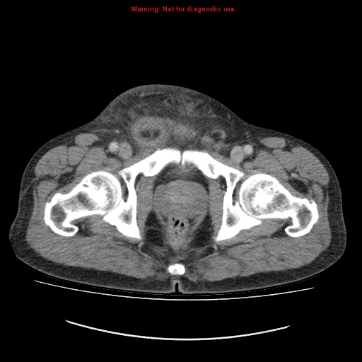 File:Appendicitis mass in inguinal hernia (Radiopaedia 26858-27029 A 29).jpg