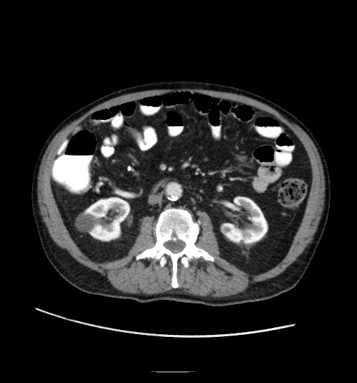 Appendicitis with localized perforation and abscess formation (Radiopaedia 49035-54130 A 44).jpg