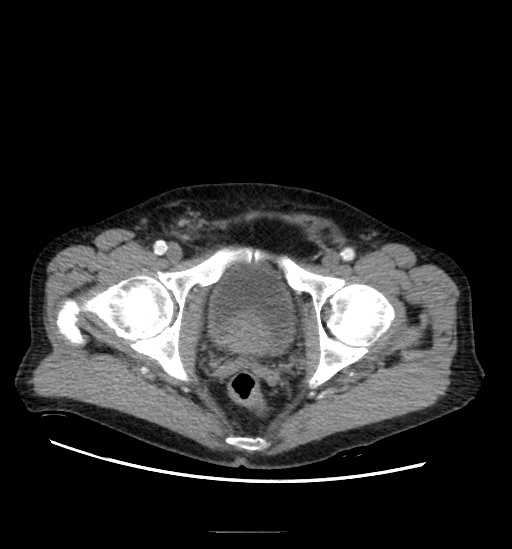Appendicitis with localized perforation and abscess formation (Radiopaedia 49035-54130 A 82).jpg