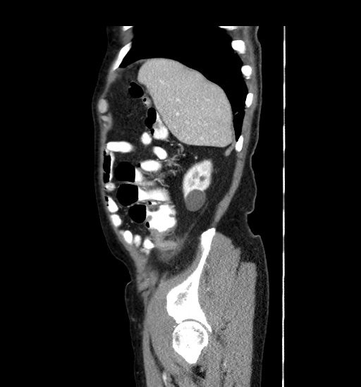 Appendicitis with localized perforation and abscess formation (Radiopaedia 49035-54130 C 12).jpg