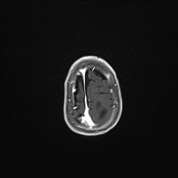 Aqueductal stenosis (Radiopaedia 73974-84802 Axial T1 C+ 134).jpg
