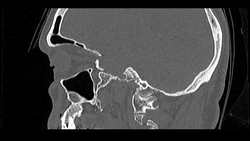Arcuate foramen (Radiopaedia 89833-106944 Sagittal bone window 96).jpg