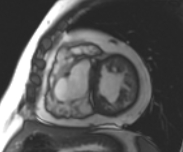 File:Arrhythmogenic right ventricular cardiomyopathy (Radiopaedia 69431-79307 Short axis cine 114).jpg