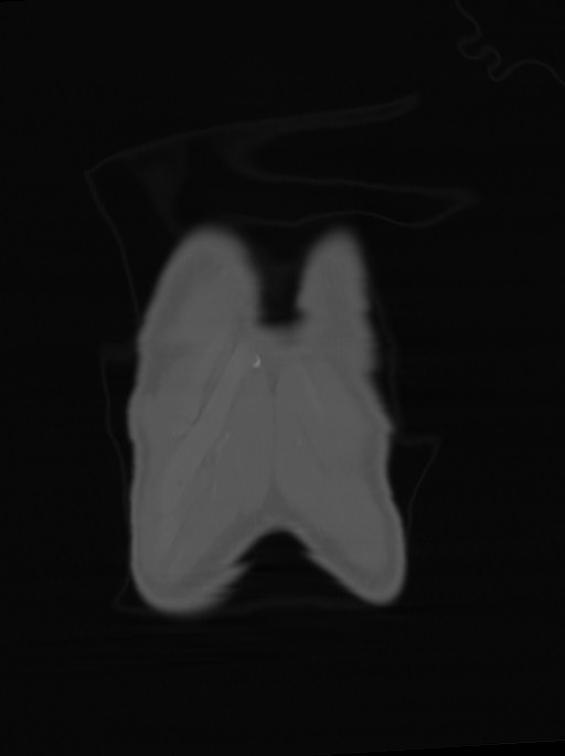 Arrow injury to the neck (Radiopaedia 75225-86323 Coronal bone window 9).jpg