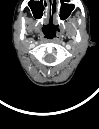 Arteriovenous malformation of the neck (Radiopaedia 53935-60062 B 5).jpg