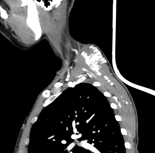 Arteriovenous malformation of the neck (Radiopaedia 53935-60062 C 18).jpg