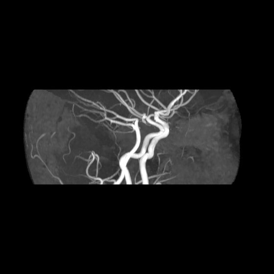 File:Artery of Percheron infarct (Radiopaedia 40966-43676 G 5).jpg