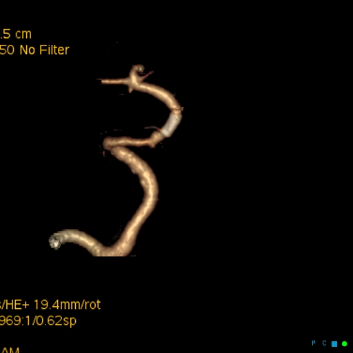 File:Artifactual basilar artery stenosis due to metallic stent (Radiopaedia 31206-31923 C 10).jpg