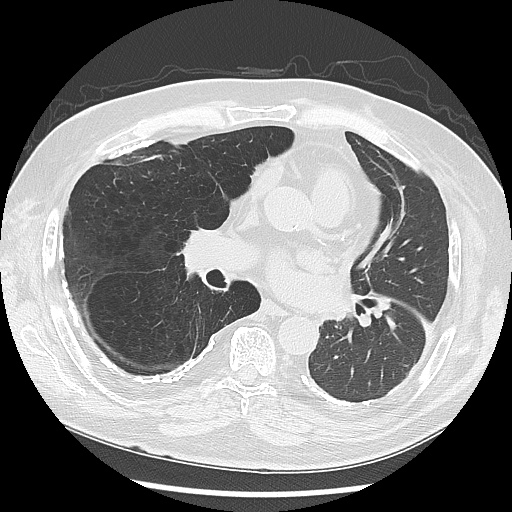 Asbestos-related pleural disease (Radiopaedia 74366-85250 Axial lung window 61).jpg