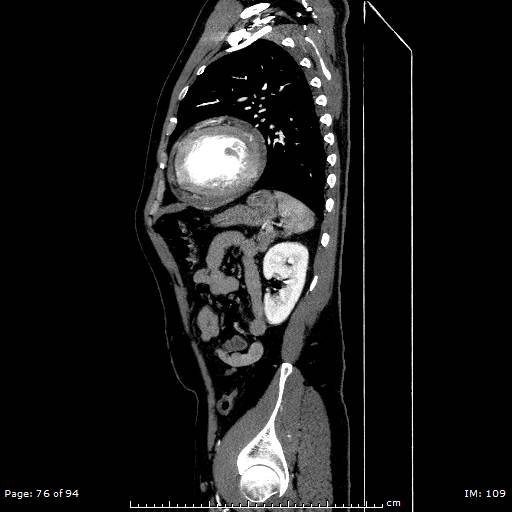 Ascending aortic aneurysm (Radiopaedia 50086-55404 C 54).jpg